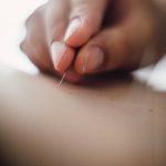 acupuncture Longueuil