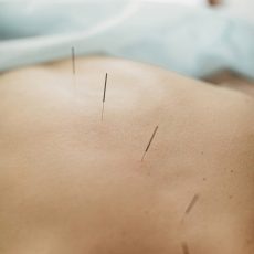 acupuncture sur le dos